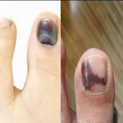 买2发专用药甲净修复液黑指甲