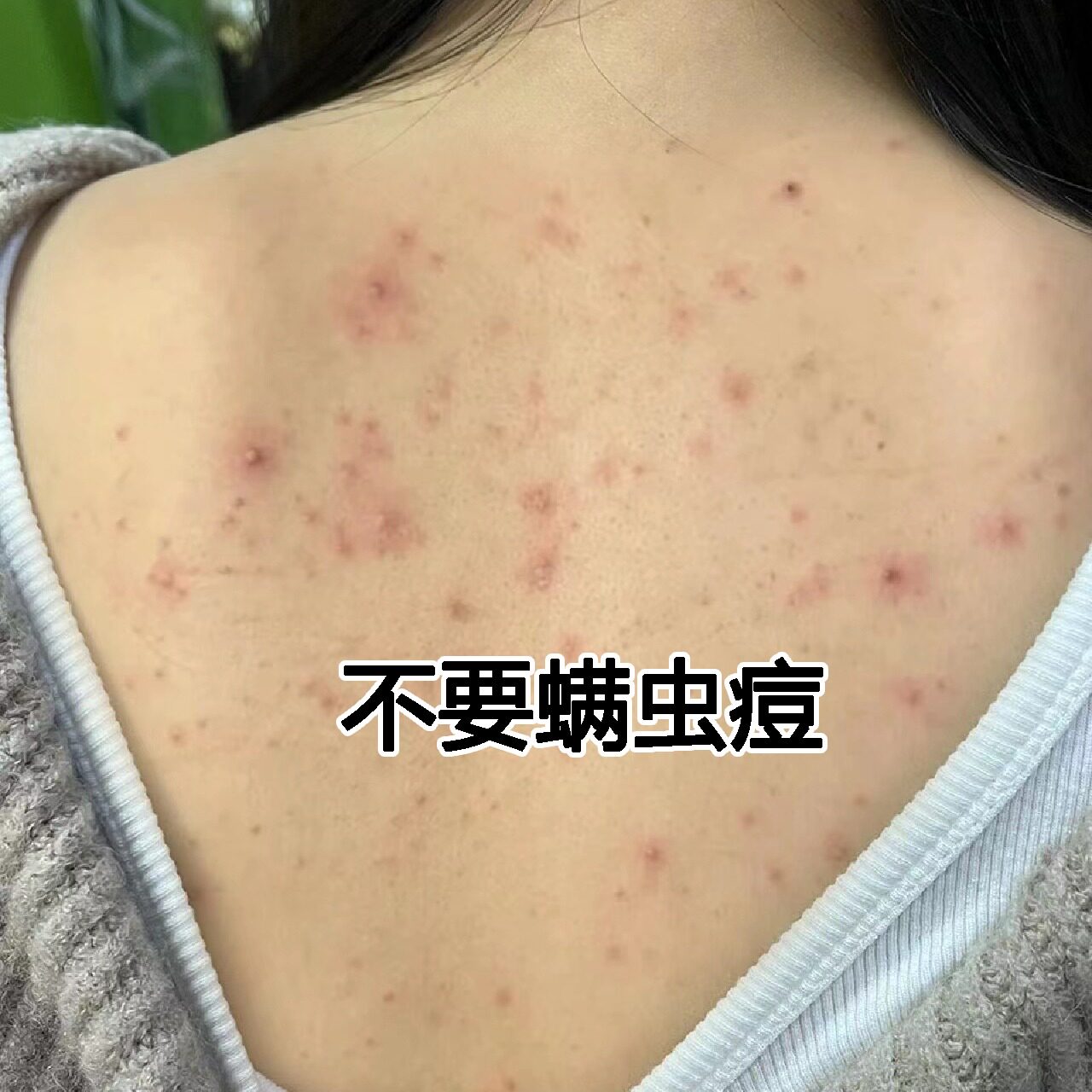 屈臣氏推荐~背部去螨虫喷雾 不要后背豆豆和豆豆说拜拜背部无逗