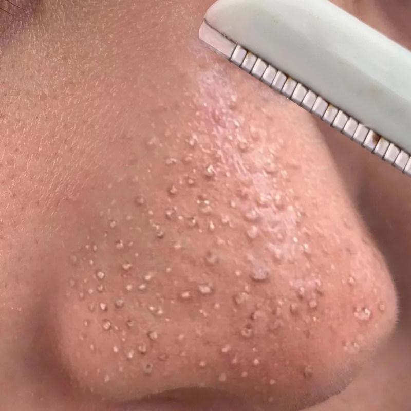 【屈臣氏超火 买2送1】清洁脸上毛孔垃圾 乳糖酸收缩毛孔