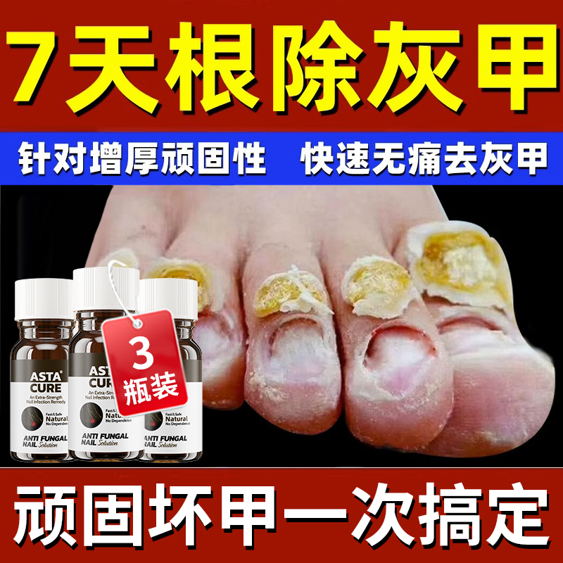 灰指甲治疗专用药特效药根治正品旗舰店甲沟炎指甲刀修脚刀冰醋酸