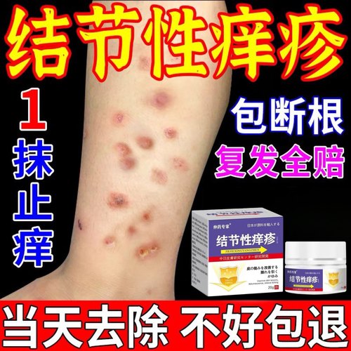结节性痒疹皮肤病止痒