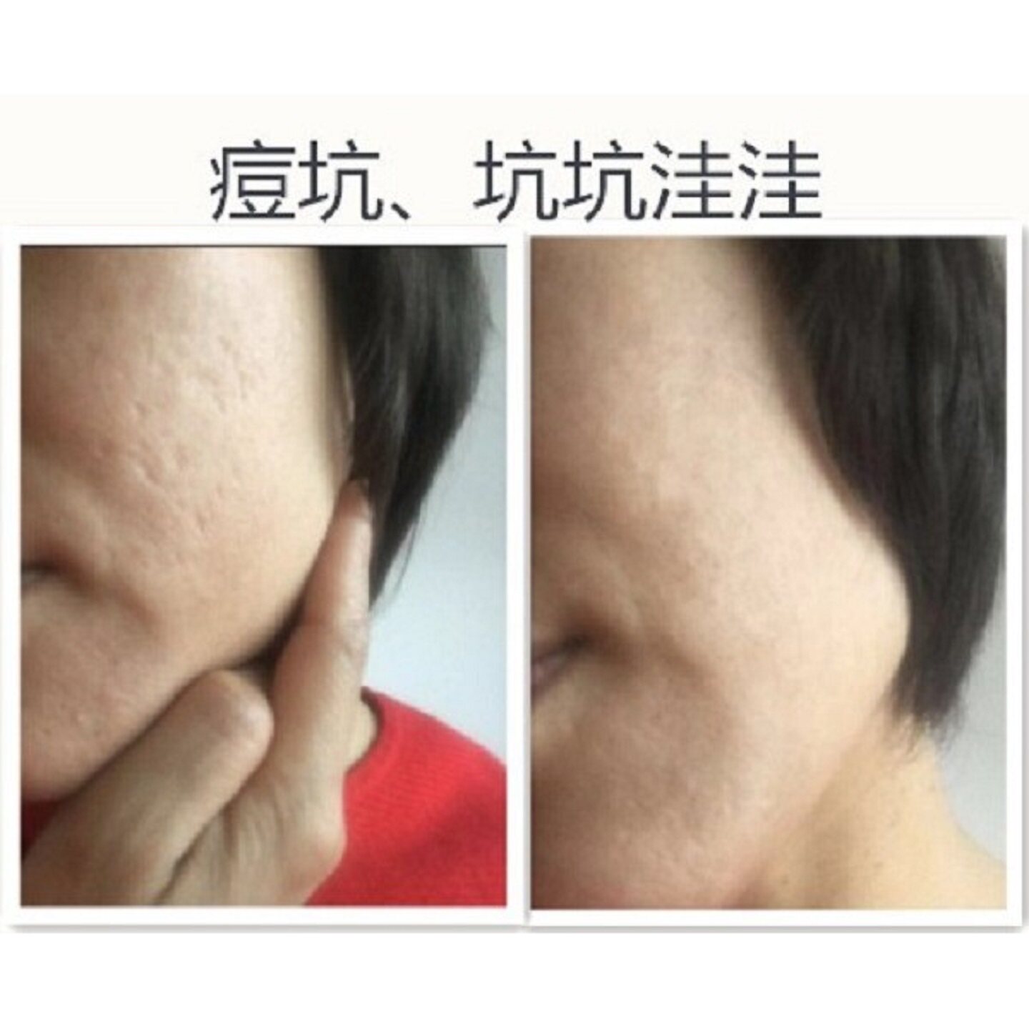 祛痘印痘坑凹洞修复男女士去痘疤痣坑淡化膏填充微针消水再生神器