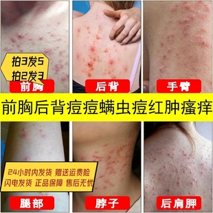 治疗瘙痒止痒特效苗家皮肤草本抑菌神经性皮炎根去除外用膏疹药湿