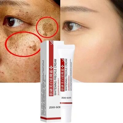 Whitening Freckle Cream Remove Dark Spots Anti Freckle Face
