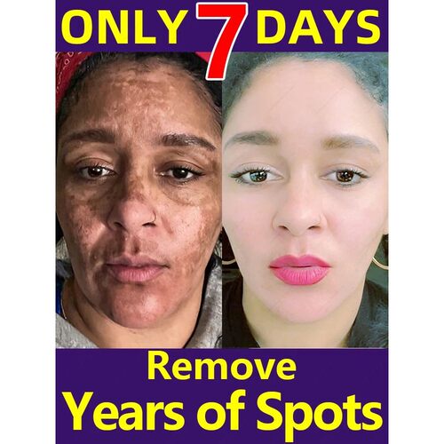 Freckle Whitening Cream Melasma Removal Dark Spots Fade Brig
