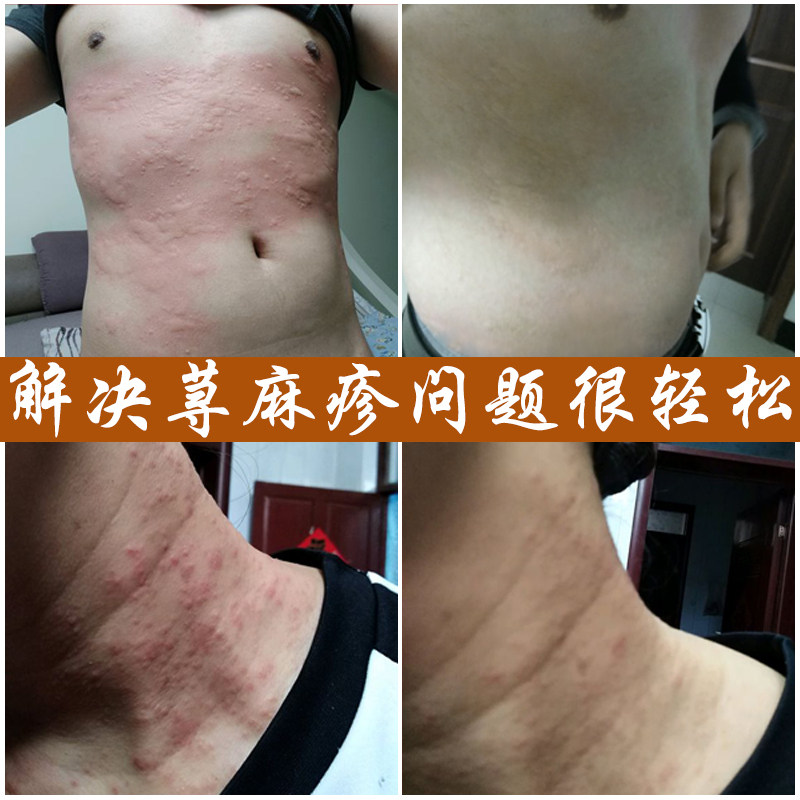 专用治療慢性寻荨麻疹外用药断根风团过敏皮肤瘙痒止痒日本中药膏在类目 本地化生活服务, 健康服务, 健康服务, 在线问诊, 内容分答中 - 来自Buy2taobao.com提供专业的淘宝代购服务