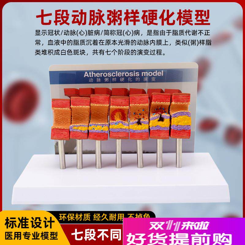 人体心脑血管动脉粥样硬化堵塞y模型血栓血液脂肪病理解剖医学教