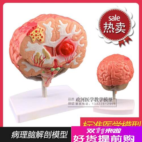 仿真人体脑部疾病模型大脑解A剖神经内外科脑病理大脑病变模型