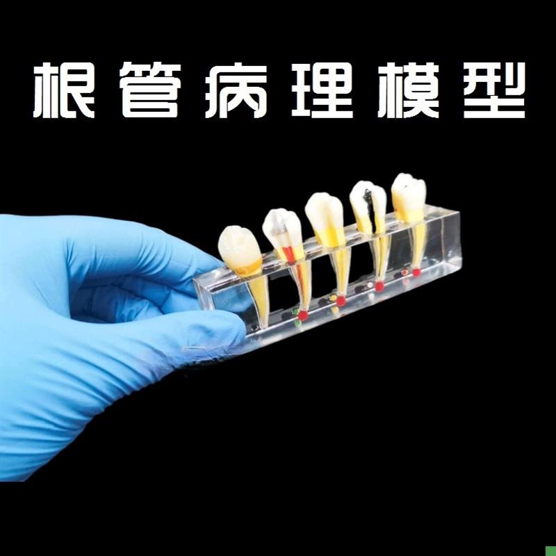 牙科口腔a教学模型蛀牙龋坏发展演示水晶根管成人病理模型牙齿展