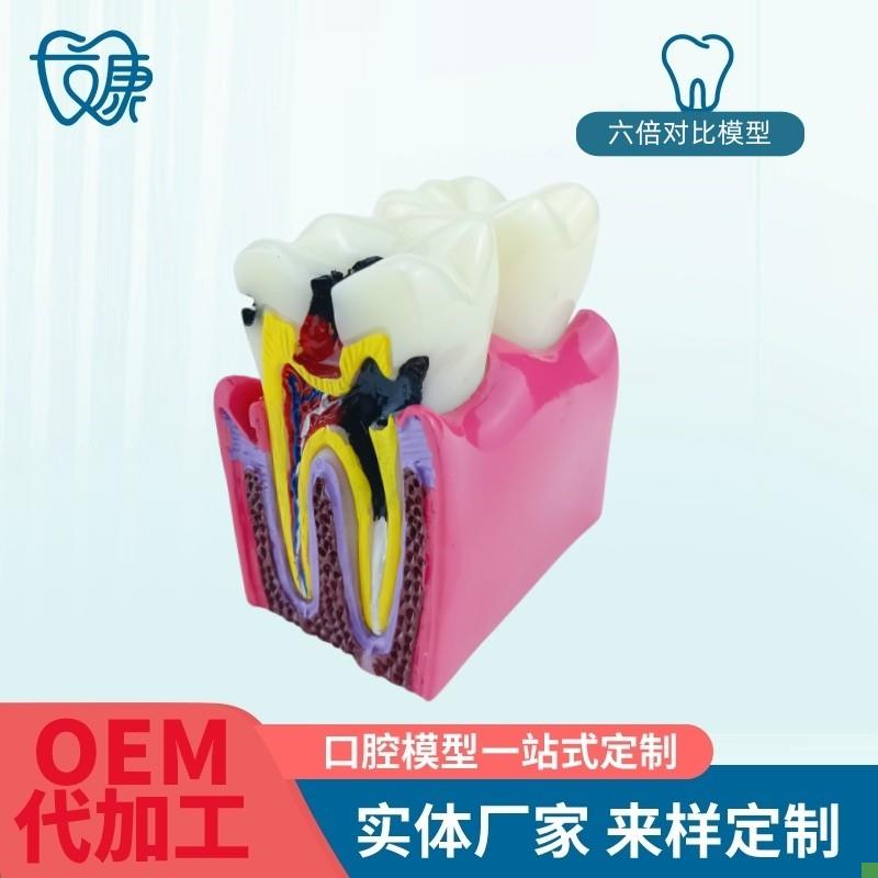 6倍对比模型牙科教学器材6倍龋齿对比模型口腔模型教Z学牙齿模型