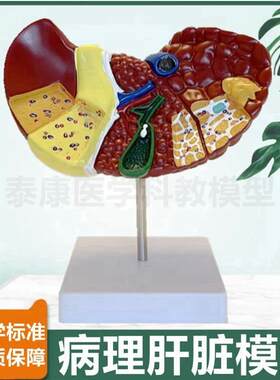 病理肝脏模型临床常见肝胆胰外科医生用胰腺脾脏十二X指肠消化系