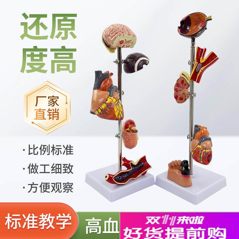 高/血压模型糖尿/病变内脏模型病F态血压病理脑眼心脏肾脏血管