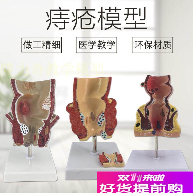 大肠结肠直肠痔疮病变q模型内外直肠痔疮肛门肛肠科模型直肠病理