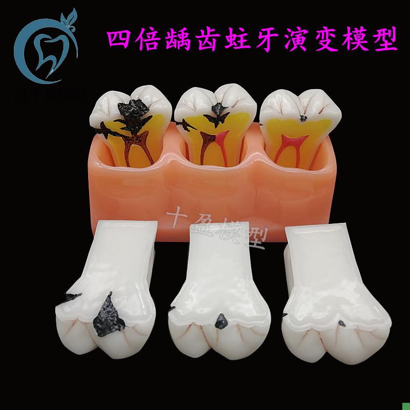 牙齿模型四倍龋齿演变模型蛀牙演示C医患沟通龋齿发展病理分解模M