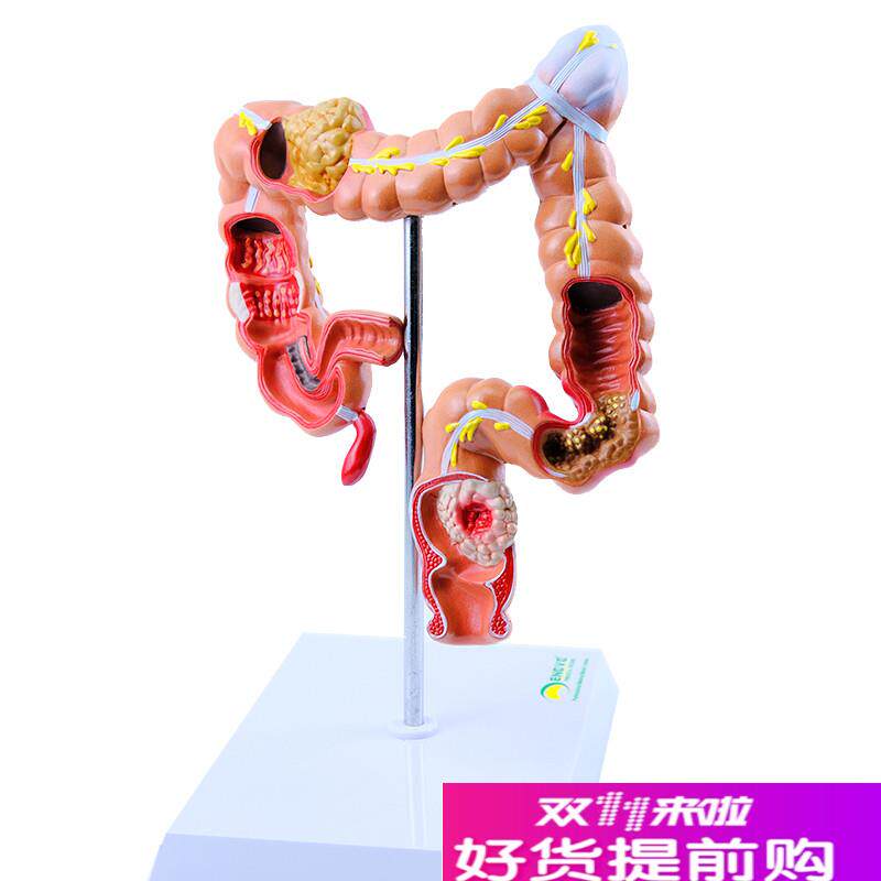 ENOVO颐诺人体大肠疾病展示模型结G肠直肠道病变症状消化系统疾病