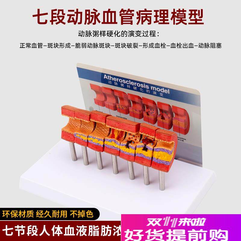 仿真人体心脑血管动脉粥样硬化堵塞模型血栓血液脂肪W病理解剖教