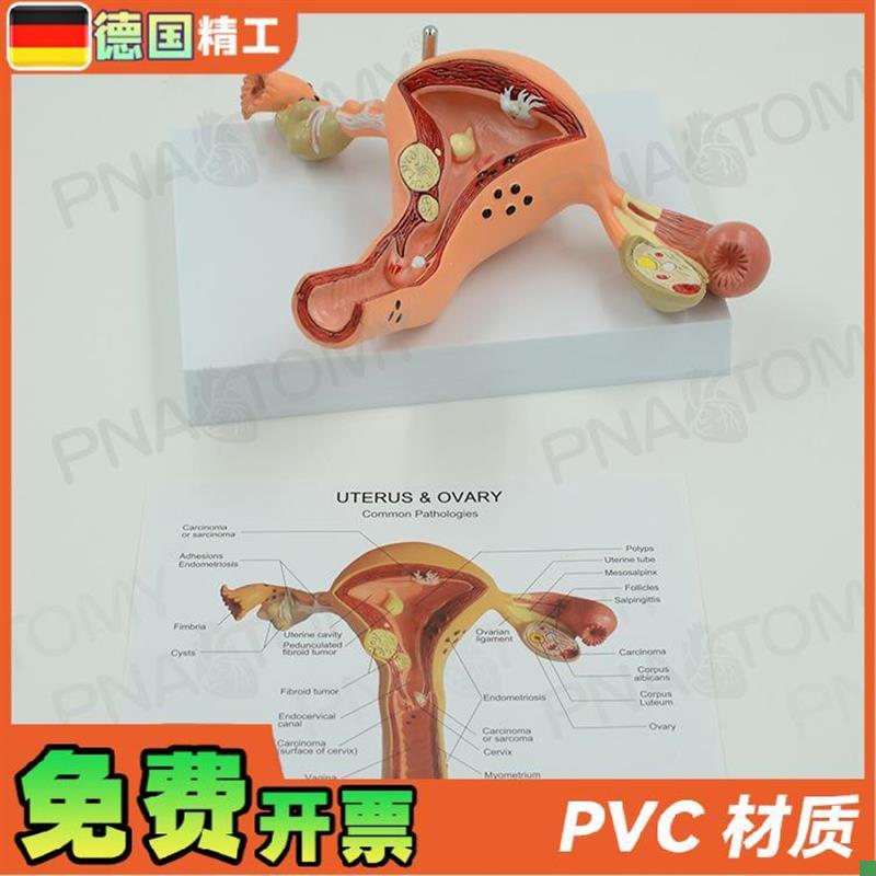 德国】女性子宫卵巢病q理病变模型生殖科妇产科教学计生医学教学