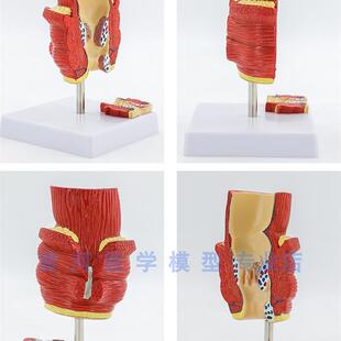 人体直肠病变模型k病理直肠模型病理痔疮肛门医患沟通教学模型