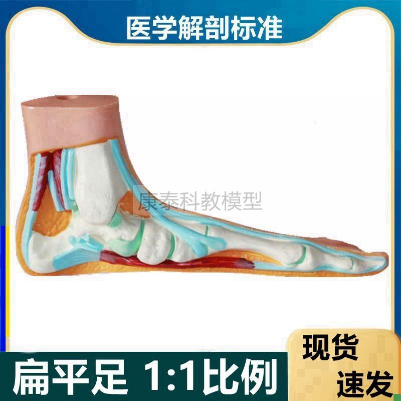 畸形脚模型高弓足爪行扁平脚足底解剖踝关节O骨骼肌肉康复功能模