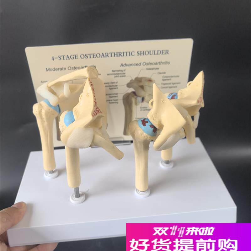 人体肩关节模h型病理肩关节随年病变病理关节骼关节模型