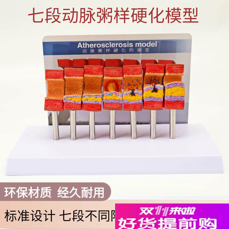 动脉粥样硬化模型血管血栓栓塞模型动脉血管人体R医用医学教学模