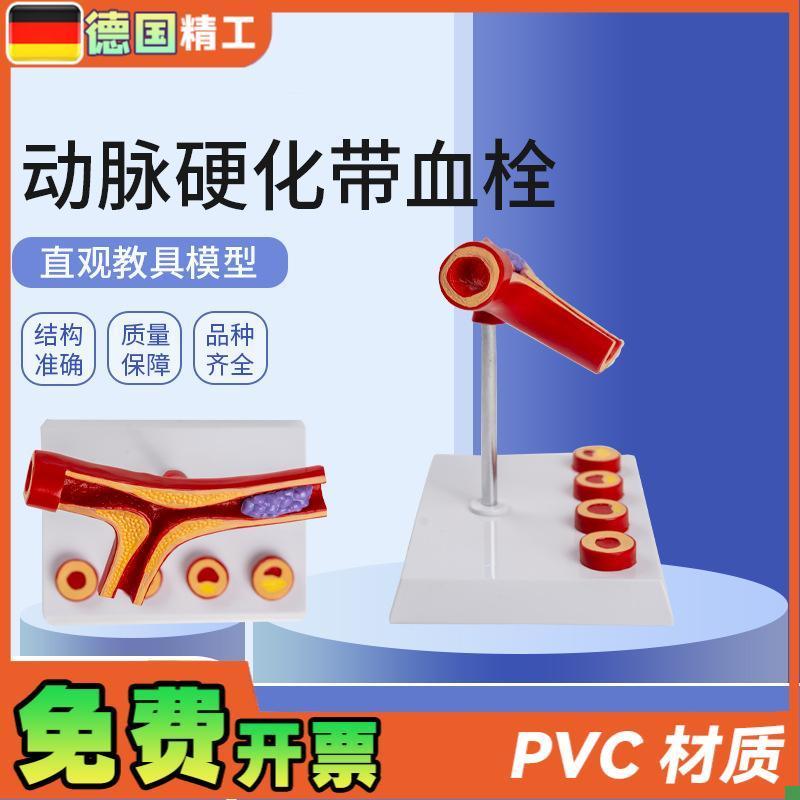 德国】动脉带血栓模型5部件y血管堵4塞血管粥样血管病理解剖