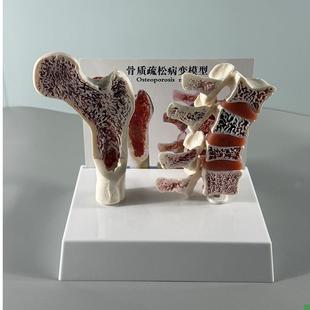 康泰医学教具骨质疏松模型骨密度变D化骨折病变人体骨骼脊柱椎间