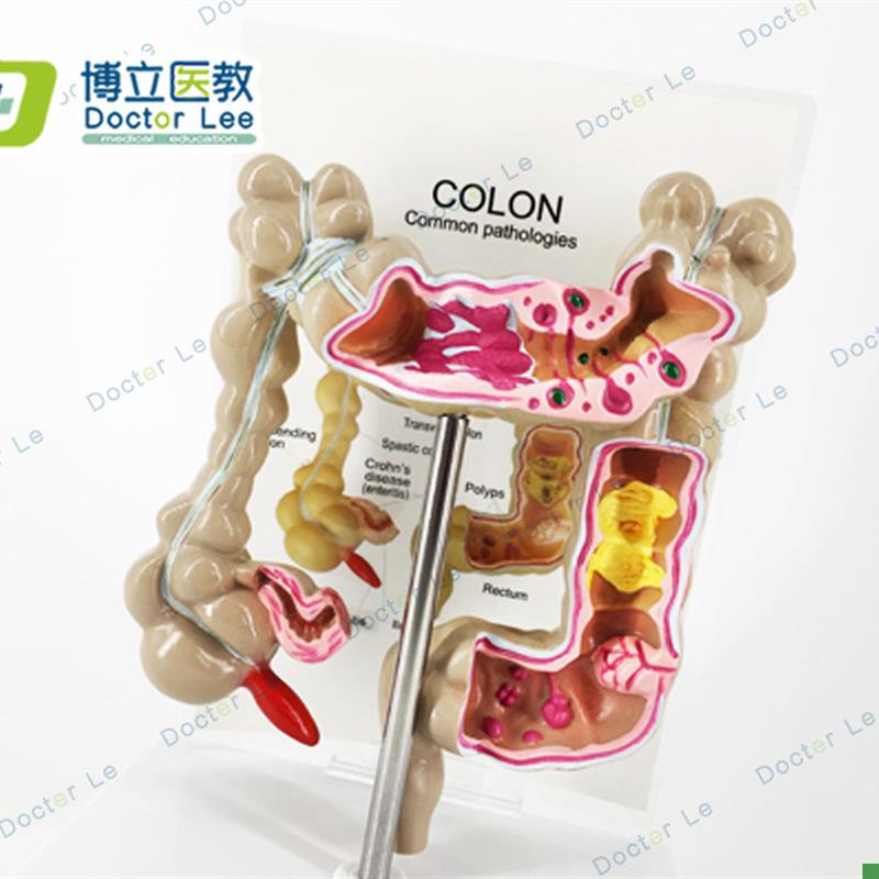 教学仿真结e肠病理模型大肠病变标本肠道医患沟通交流人体器官解