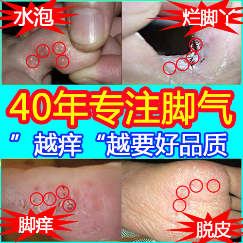 脚气止痒脱皮杀菌水泡烂脚丫脚痒脚藓皮肤瘙痒抑菌神器百草膏外用