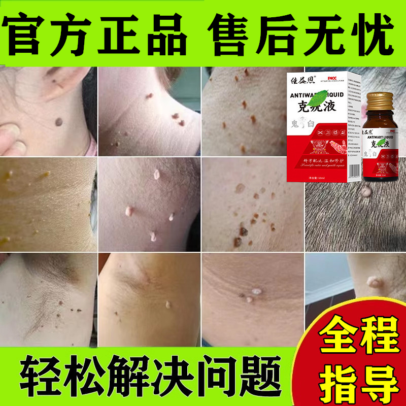 肉瘊子小肉粒疙瘩赘肉脸上防皮肤长肉丁肉疙瘩肉瘊子凸起脖子腋下