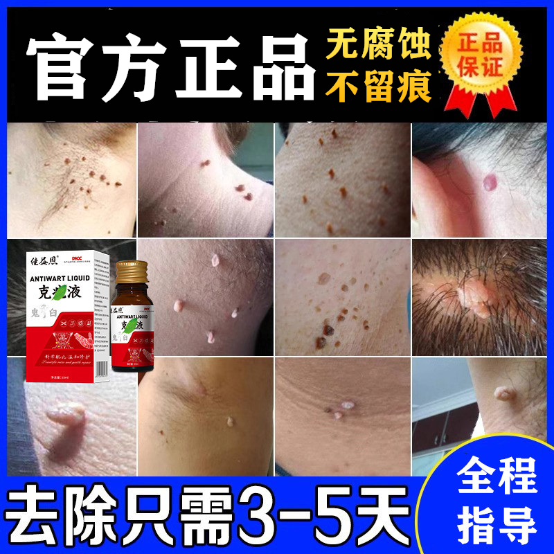 10ml鬼臼毒素酊乳膏复方竹叶草脂足叶草酯治非疗男女尖锐