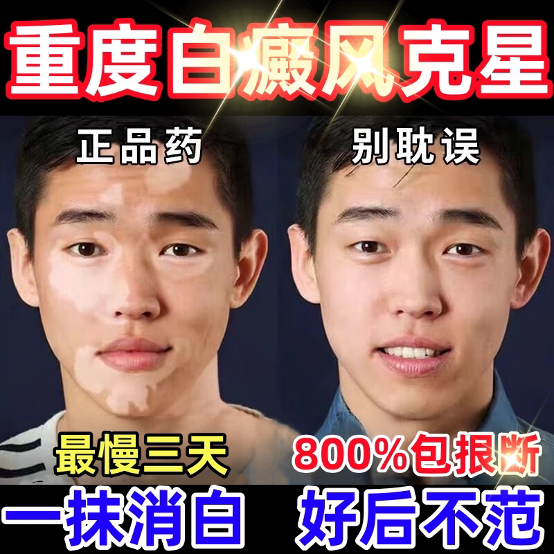 白癜特风药效专用补骨脂酊促进黑色素生长外用快速消白斑进口膏药