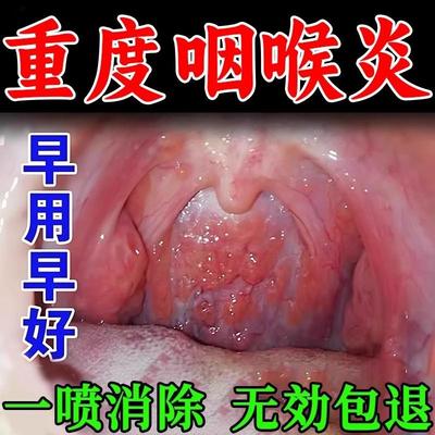 咽喉慢性咽炎除根喷雾剂药治喉咙滤泡增生润烟喉糖异物感贴专用炎
