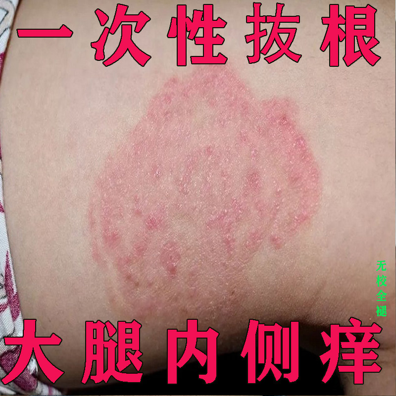 大腿内侧股藓专用膏皮肤瘙痒男女皮肤消毒护理（消）