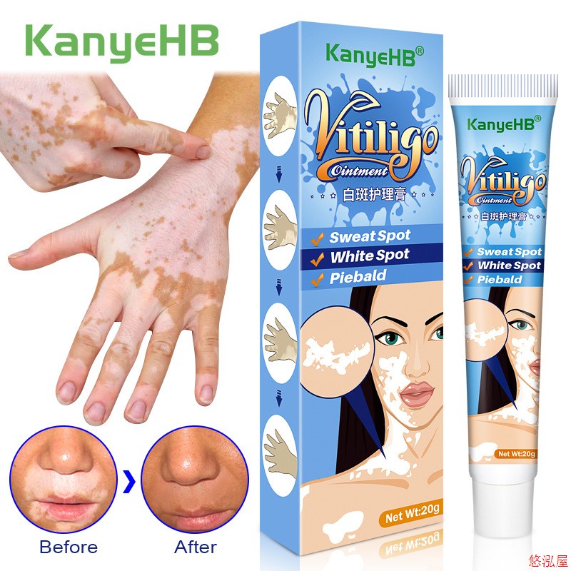 20g Herbal Extract Vitiligo Ointment Remove Ringworm White S