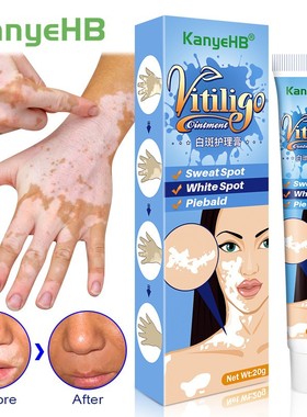 20g Herbal Extract Vitiligo Ointment Remove Ringworm White S