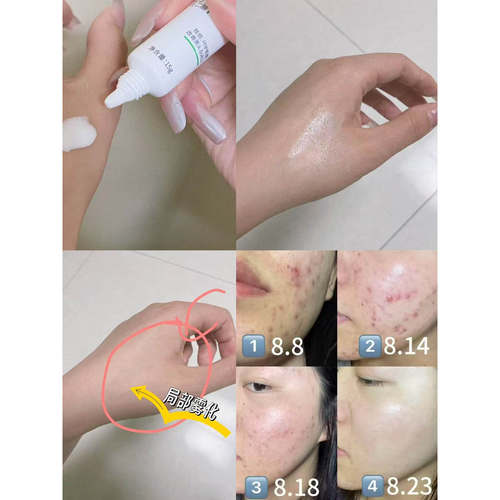 真羊毛！20%任二酸扛痘把子