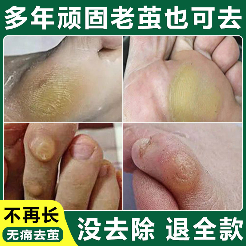 老茧去除软化剂去手上的茧子根神器祛鸡眼脚钉脚底厚脚垫膏胼胝贴