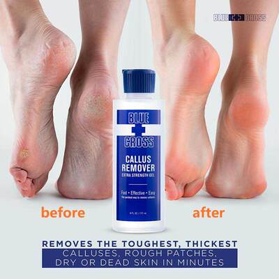 去除老茧硬皮美国软化剂蓝十字