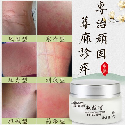 膏风团止痒过敏瘙痒症中药治疗慢性皮肤