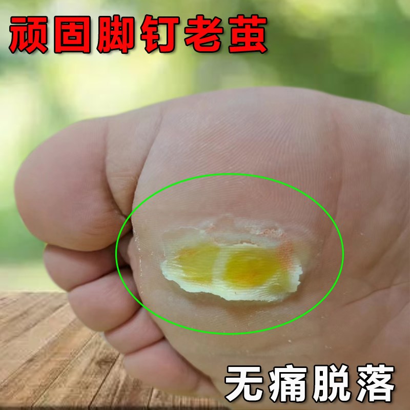 【当晚去除】脚去死皮老茧脚钉祛除硬厚脚指头掌趾硬皮软化剂神器