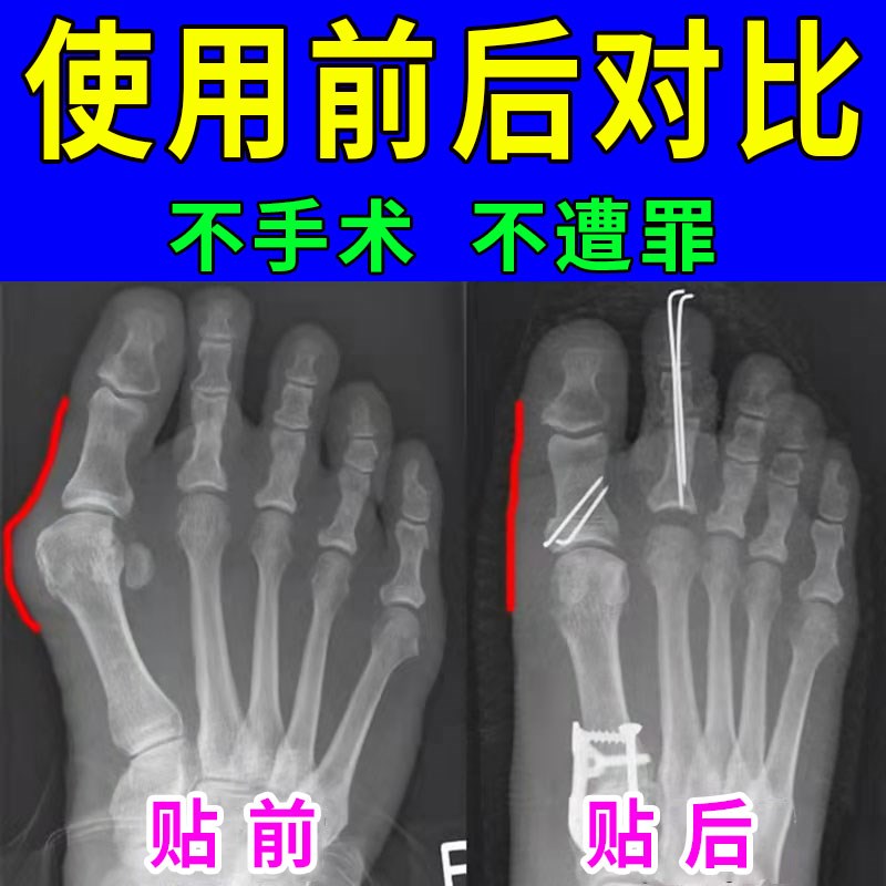 【无痛变直】拇指外翻贴脚趾重叠防磨大脚骨矫正神器外翻贴膏贴