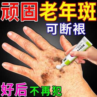 去老人斑专用药膏除老年黑班强力一抹净去除手部脸部点黄褐祛斑霜
