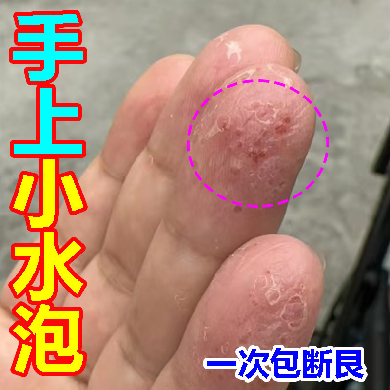 手上起水泡痒手指上掌心长水泡手痒皮肤过敏止痒脱皮杀菌汗疹膏药