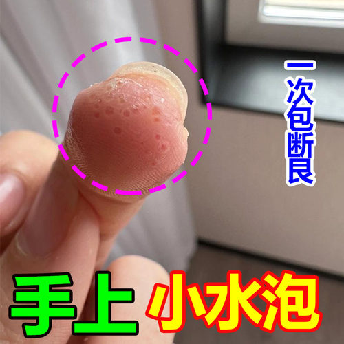 手上起小水泡汗泡疱止痒抑菌中药鹅掌风真菌感染手气湿痒疹专用膏