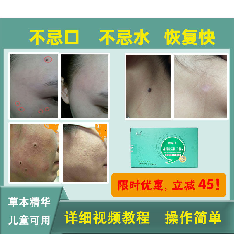 面康痣斑王各种痣小肉揪不忌水