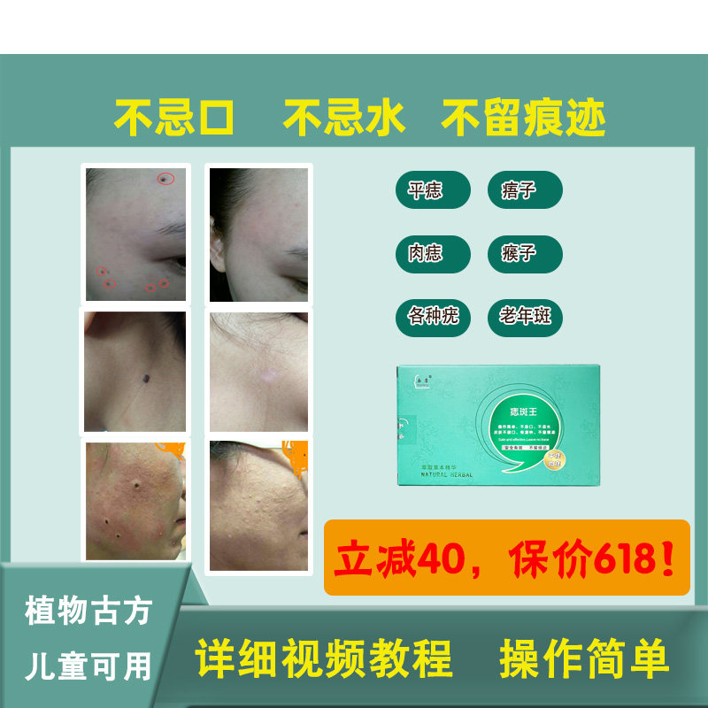 面康痣斑王点痣去痣膏正品点痦子祛痣点疣瘊子扁平老年斑面部神器