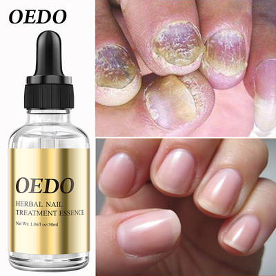 Fungal Nail Treatment Essential Oil Hand and Foot Whitening