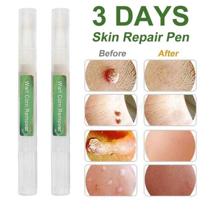 Wart Corn Remover Pen Clean Genital Warts Moles Papillomas T