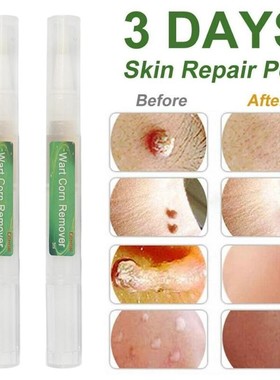 Wart Corn Remover Pen Clean Genital Warts Moles Papillomas T